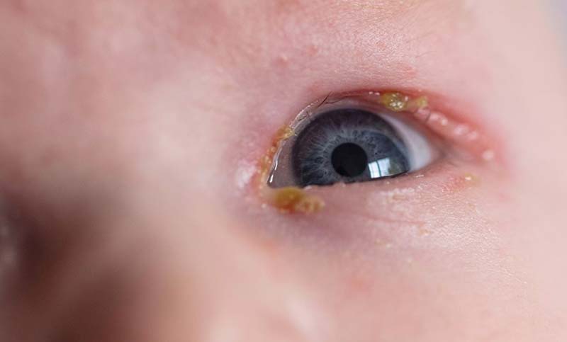 Neonatal Ophthalmia