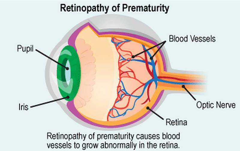 Retinopathy of Prematurity