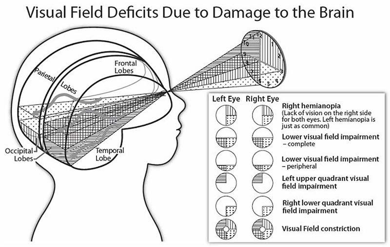 Visual Impairments from brain damage